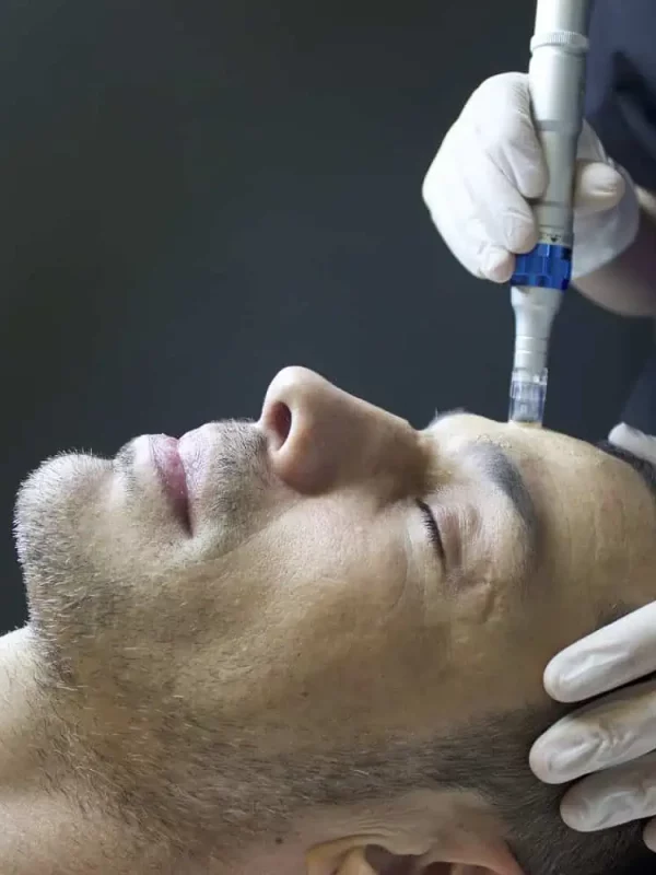 Skin Pen Microneedling-of-wywcenter-in-st.-peters-mo