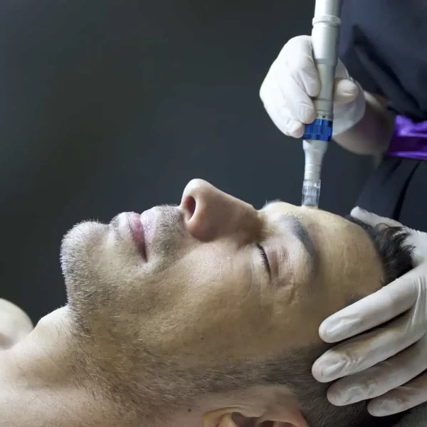 Skin Pen Microneedling-of-wywcenter-in-st.-peters-mo